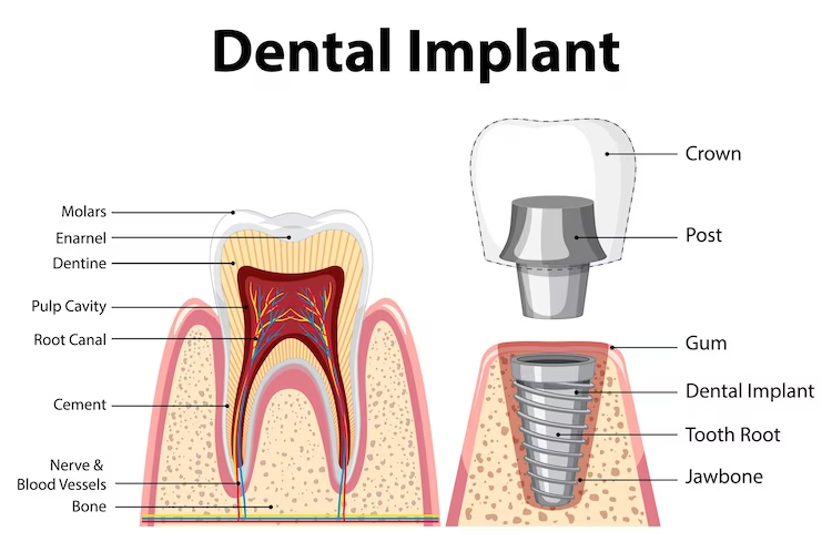 Dental implant treatment diagram showing tooth replacement